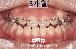 수술후