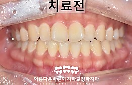 수술전
