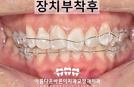 수술후