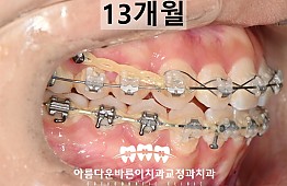 수술후