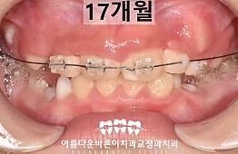 수술후
