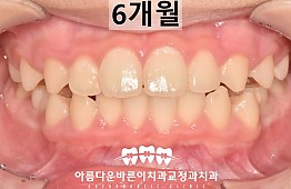 수술후