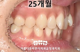수술전