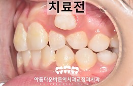 수술전