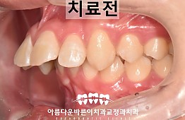 수술전