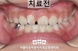 수술전