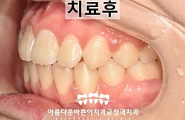 수술후