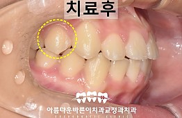 수술후