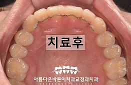 수술후