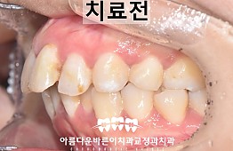수술전