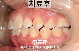 수술후