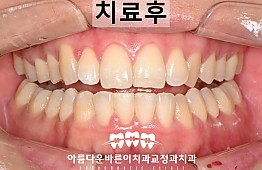 수술후