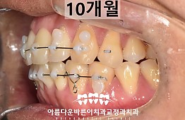 수술후