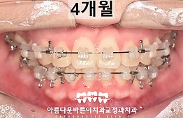 수술후