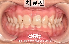 수술전