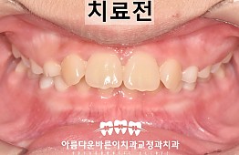 수술전