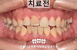 수술전
