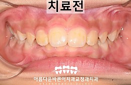 수술전
