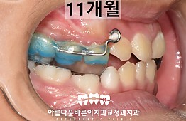 수술후