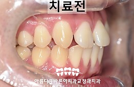 수술전