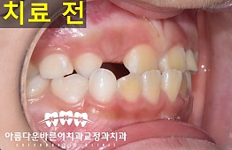 수술전