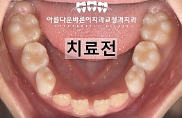 수술전