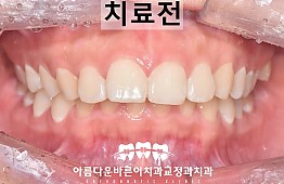 수술전