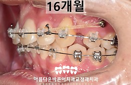 수술후