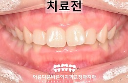 수술전