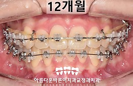 수술후
