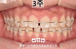 수술후