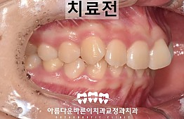 수술전