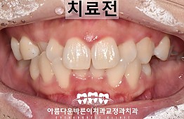 수술전