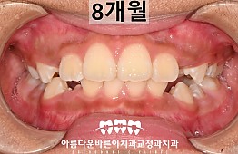 수술후