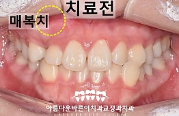 수술전