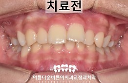 수술전