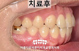 수술후