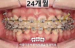 수술후