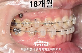 수술후