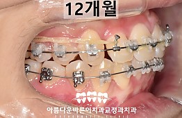 수술후