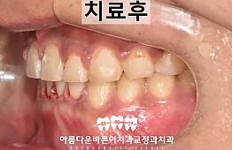 수술후