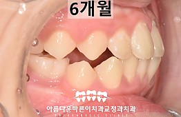 수술후