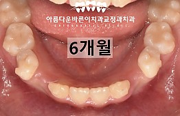 수술후