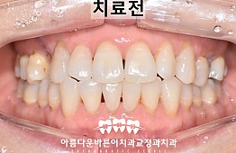 수술전