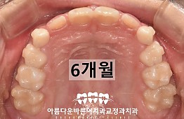 수술후