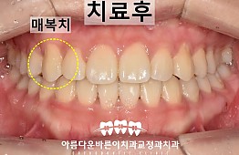 수술후