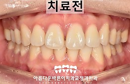 수술전