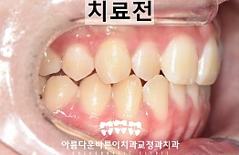 수술전