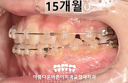 수술후