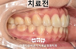 수술전